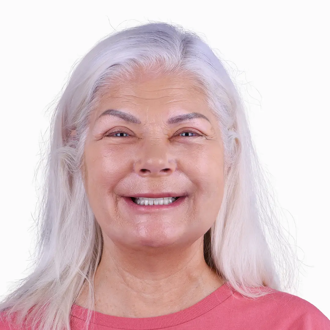 before and after all on 4 treatmen results