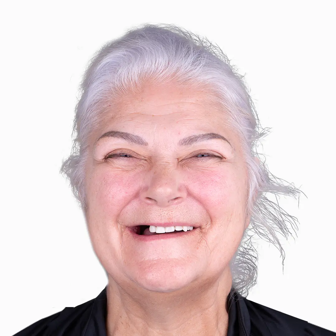 before and after all on 4 treatmen results