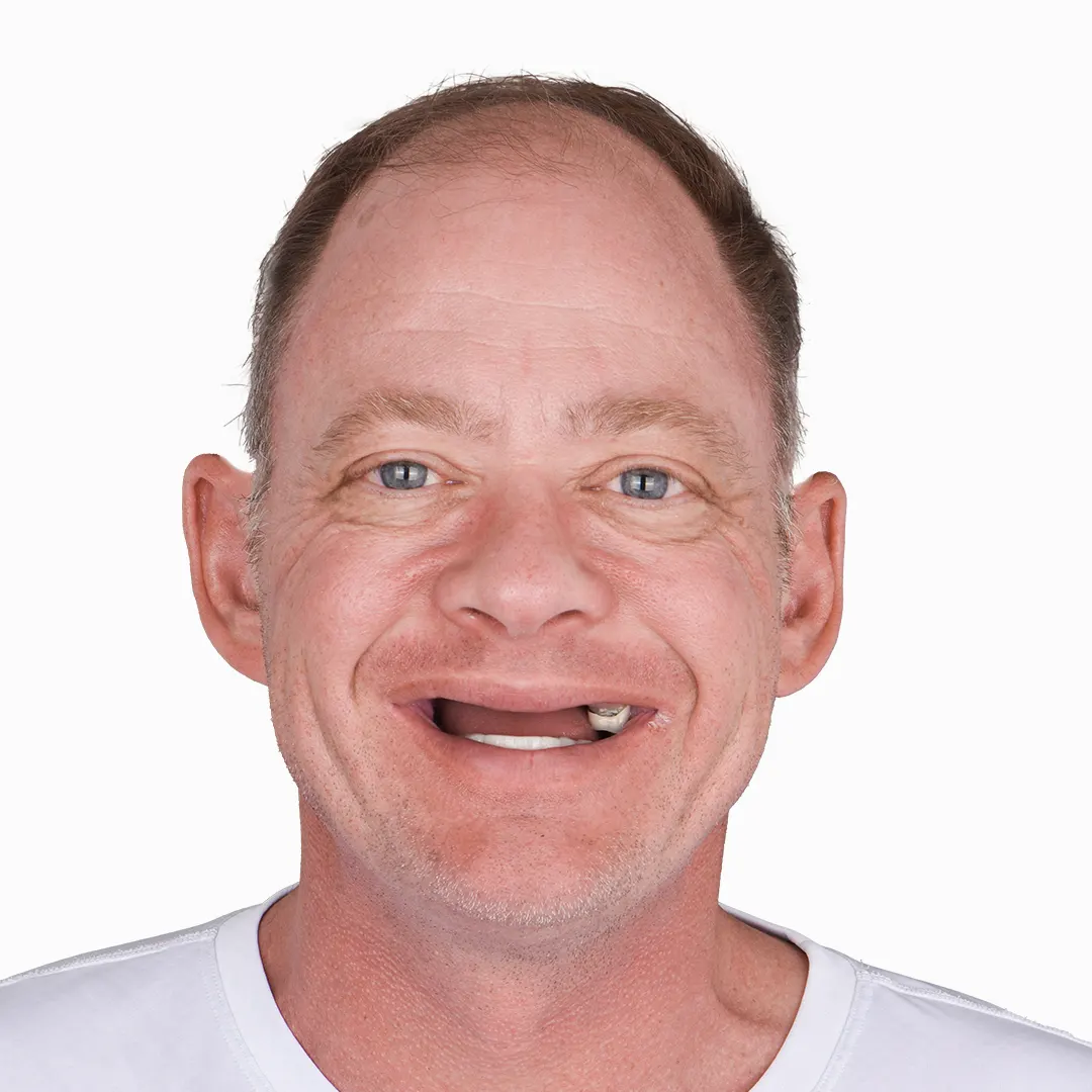 before and after all on 4 Nano Ceramic treatmen results