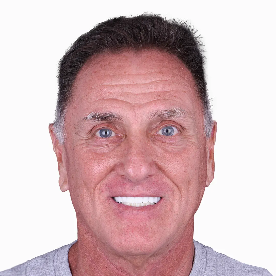 all on 4 results in vallarta dentistry