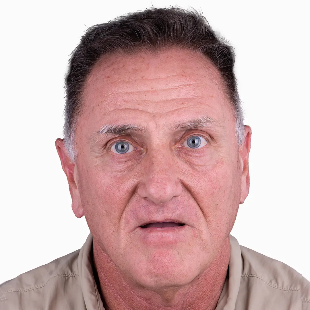 all on 4 results in vallarta dentistry