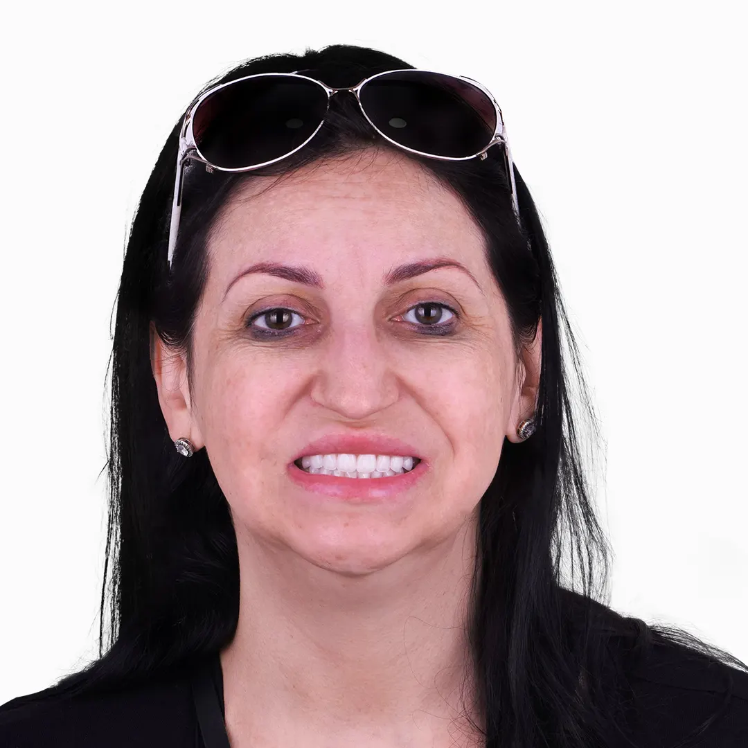 zirconia all on 4 results in vallarta dentistry