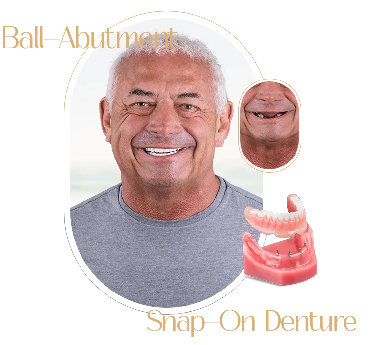 Snap On Dentures Results in Puerto Vallarta, demonstrating high-quality dental restoration work.