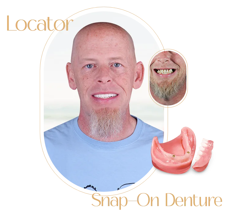 Snap In Dentures in Puerto Vallarta, demonstrating high-quality dental restoration work.