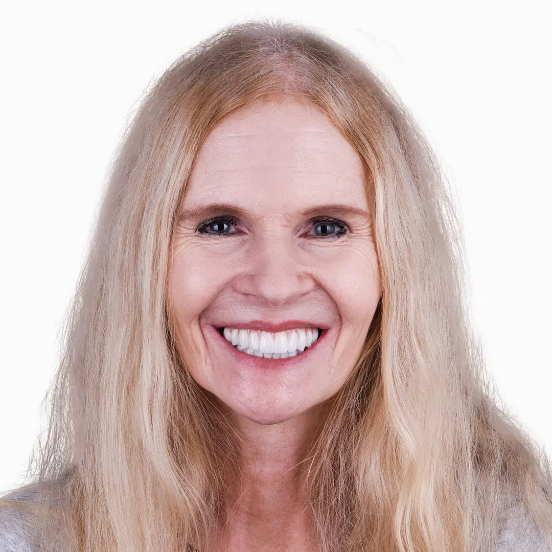 after snap on denture, 6 mini implants treatment