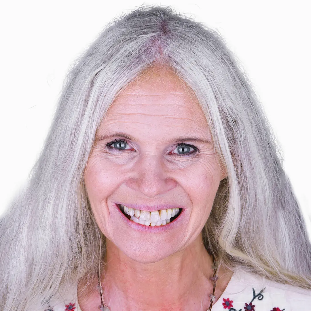 before snap on denture, 6 mini implants treatment