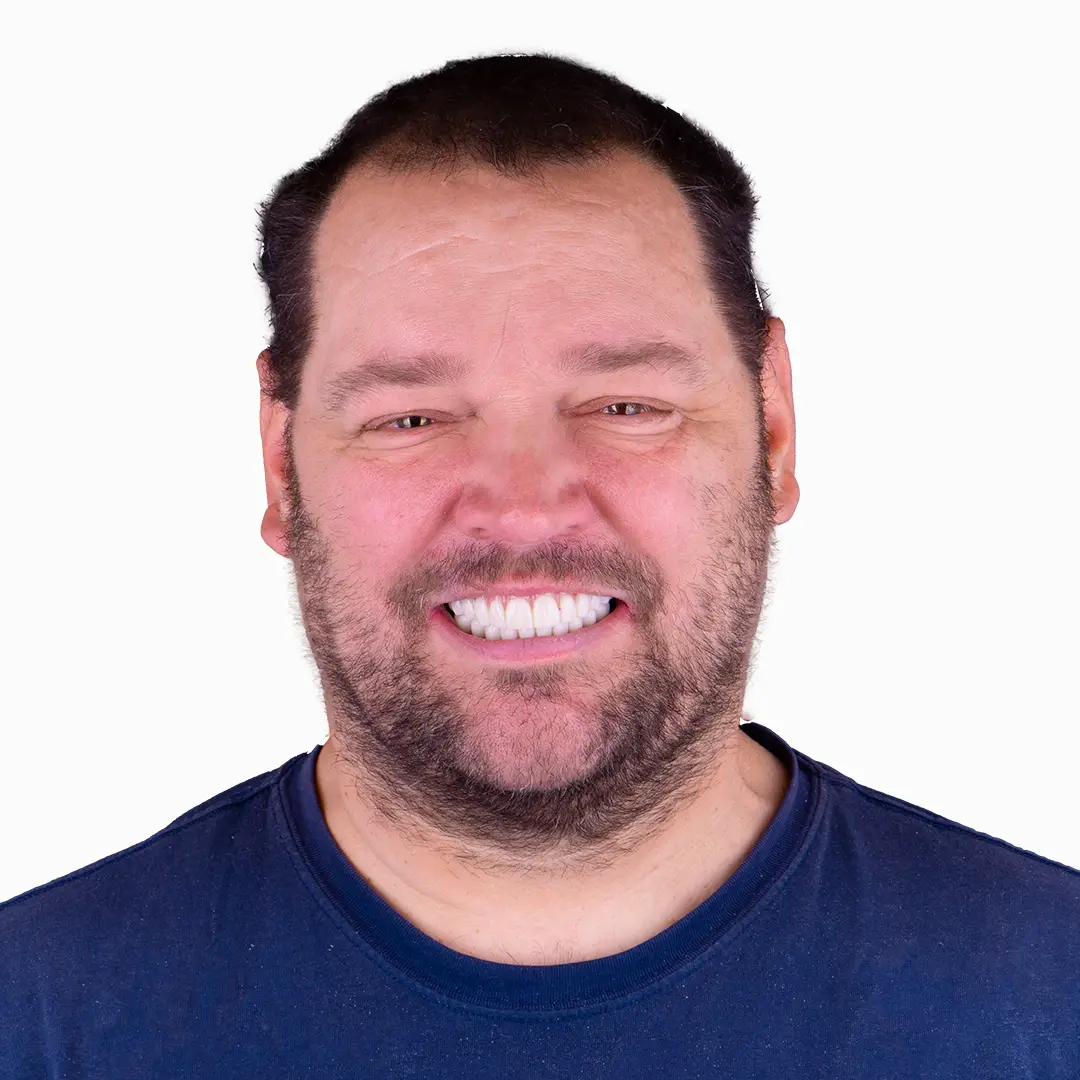 before and after snap on denture, 4 regular implants treatment