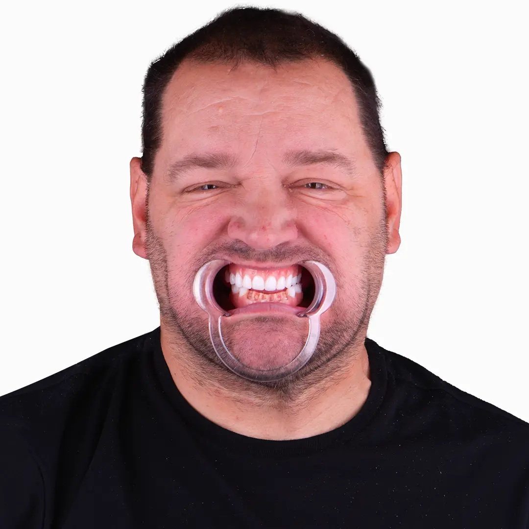 before and after snap on denture, 4 regular implants treatment