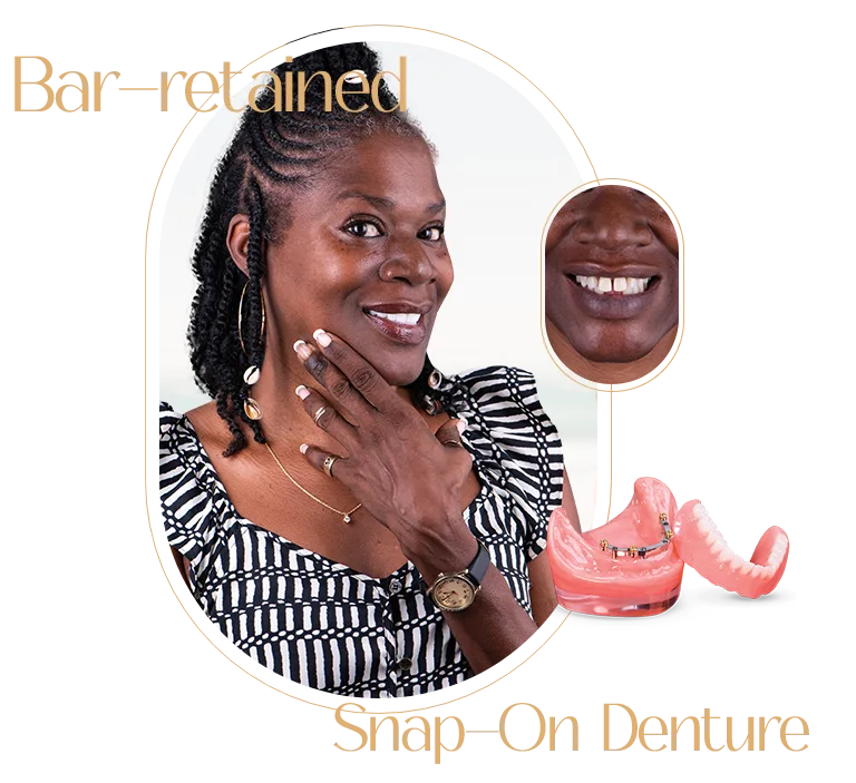 Bar-retained in Puerto Vallarta, demonstrating high-quality dental restoration work.