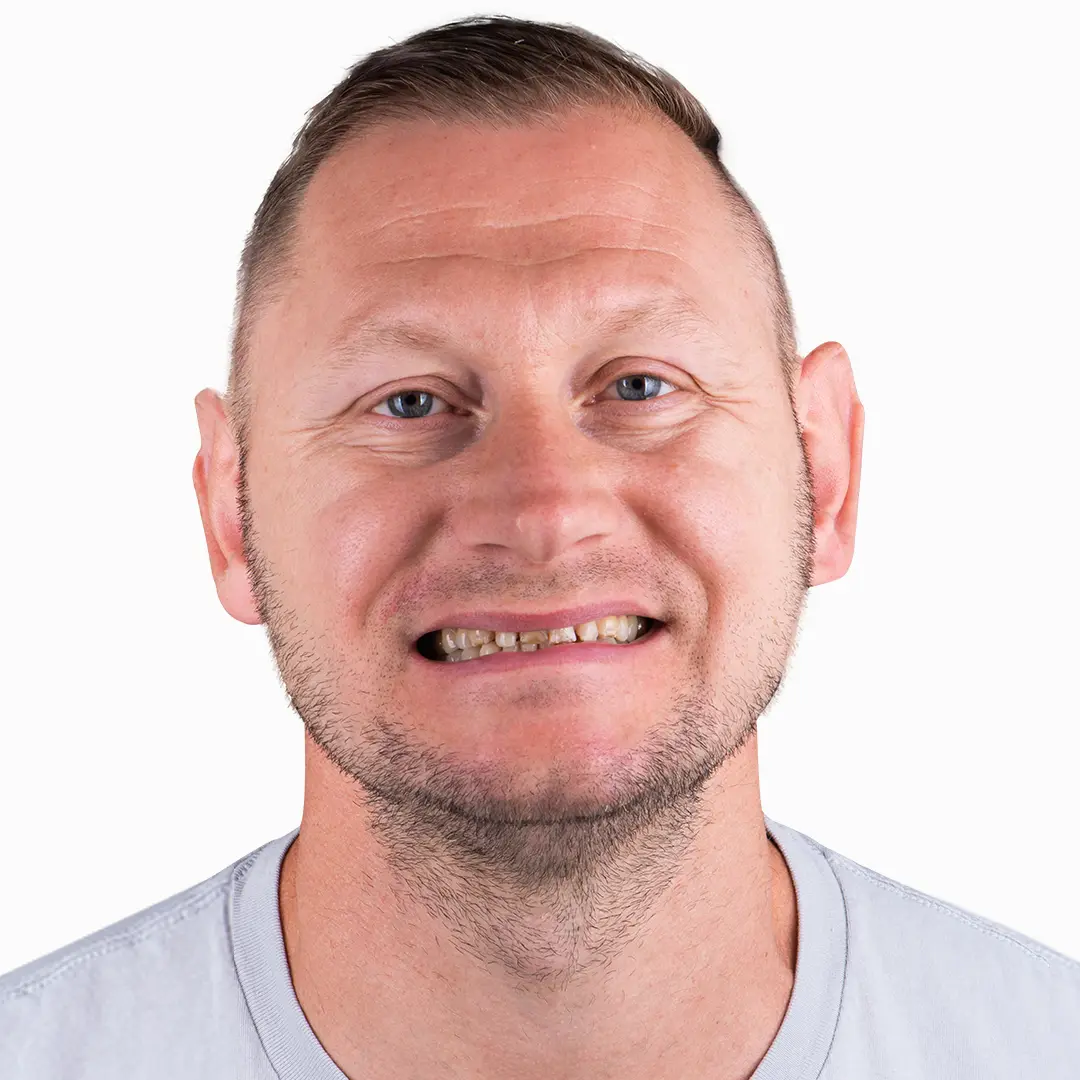 Before photo of a patient’s teeth prior to composite veneers, highlighting areas for improvement