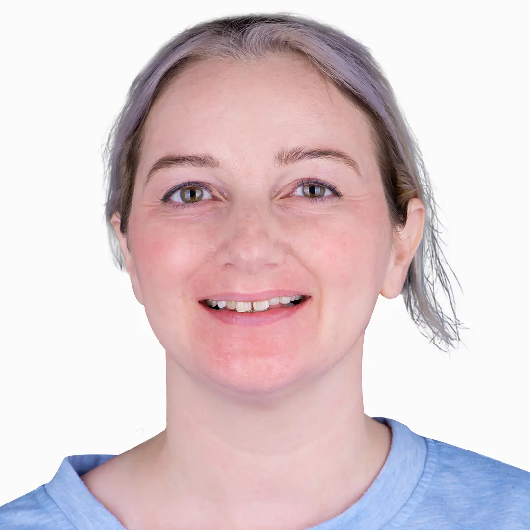 Close-up of a smile showing teeth before composite veneers treatment, emphasizing gaps and unevenness