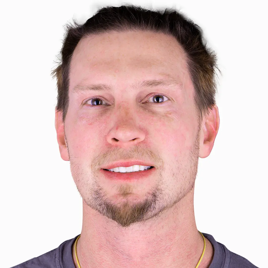 Pre-treatment smile before composite veneers, displaying discoloration and uneven spacing