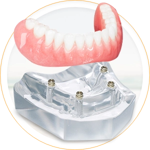 snap in denture, 4 regular implants treatment