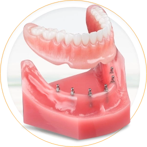 snap on denture, 6 mini implants treatment