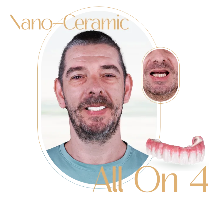 Porcelain veneers in Puerto Vallarta, demonstrating high-quality dental restoration work.