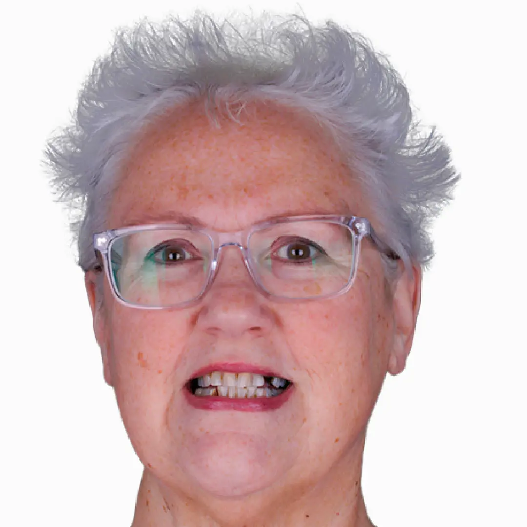 before and after full mout design in esthetic dentistry