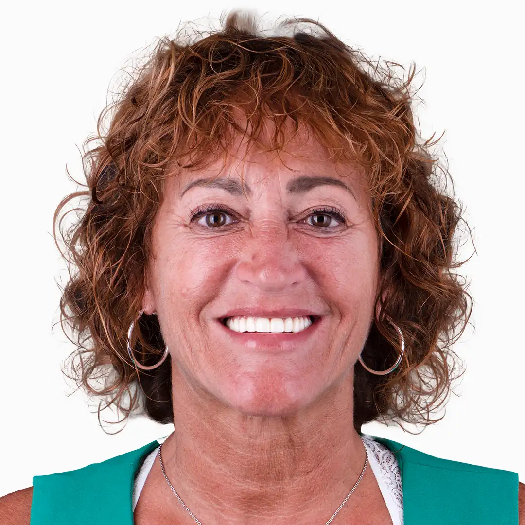 before and after snap on in puerto vallarta