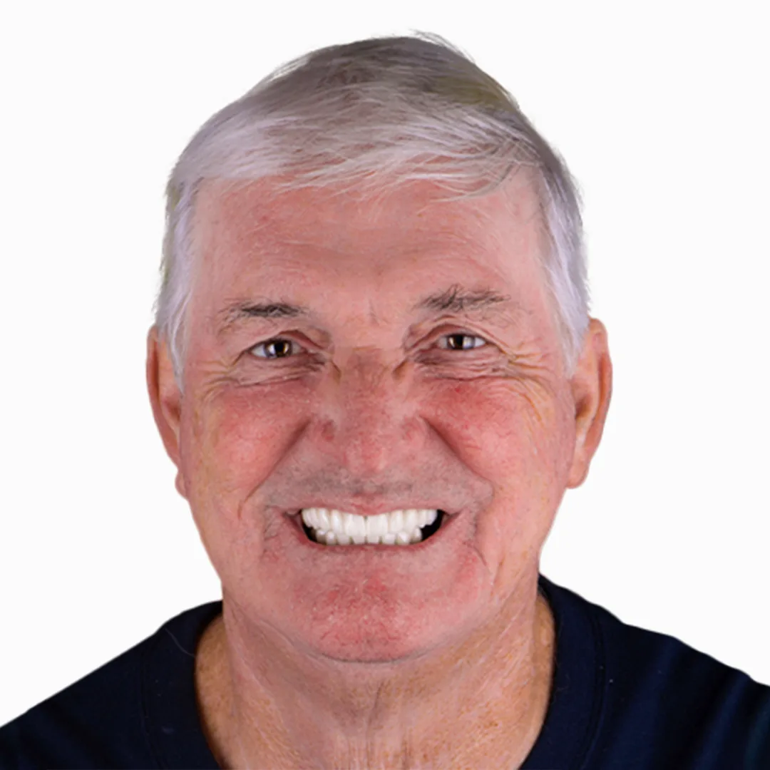 before and after snap on in dentistry vallarta esthetic