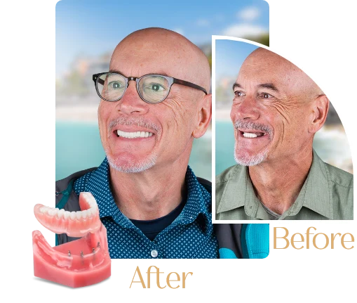 snap on before and after result in puerto vallarta