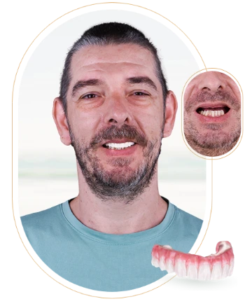 Images showcasing different aspects of veneers treatment