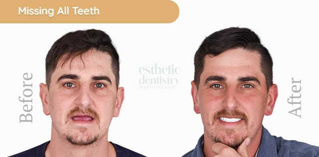 all-on-4 dental implants procedure, offering a secure and stable solution for patients needing a full arch of replacement teeth.