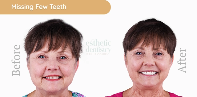 Dental bridge supported by implants, providing a stable and durable option for replacing multiple missing teeth.