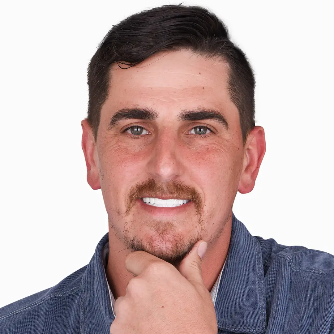 Before and after comparison of dental implants in Puerto Vallarta, showing dramatic improvement in smile aesthetics