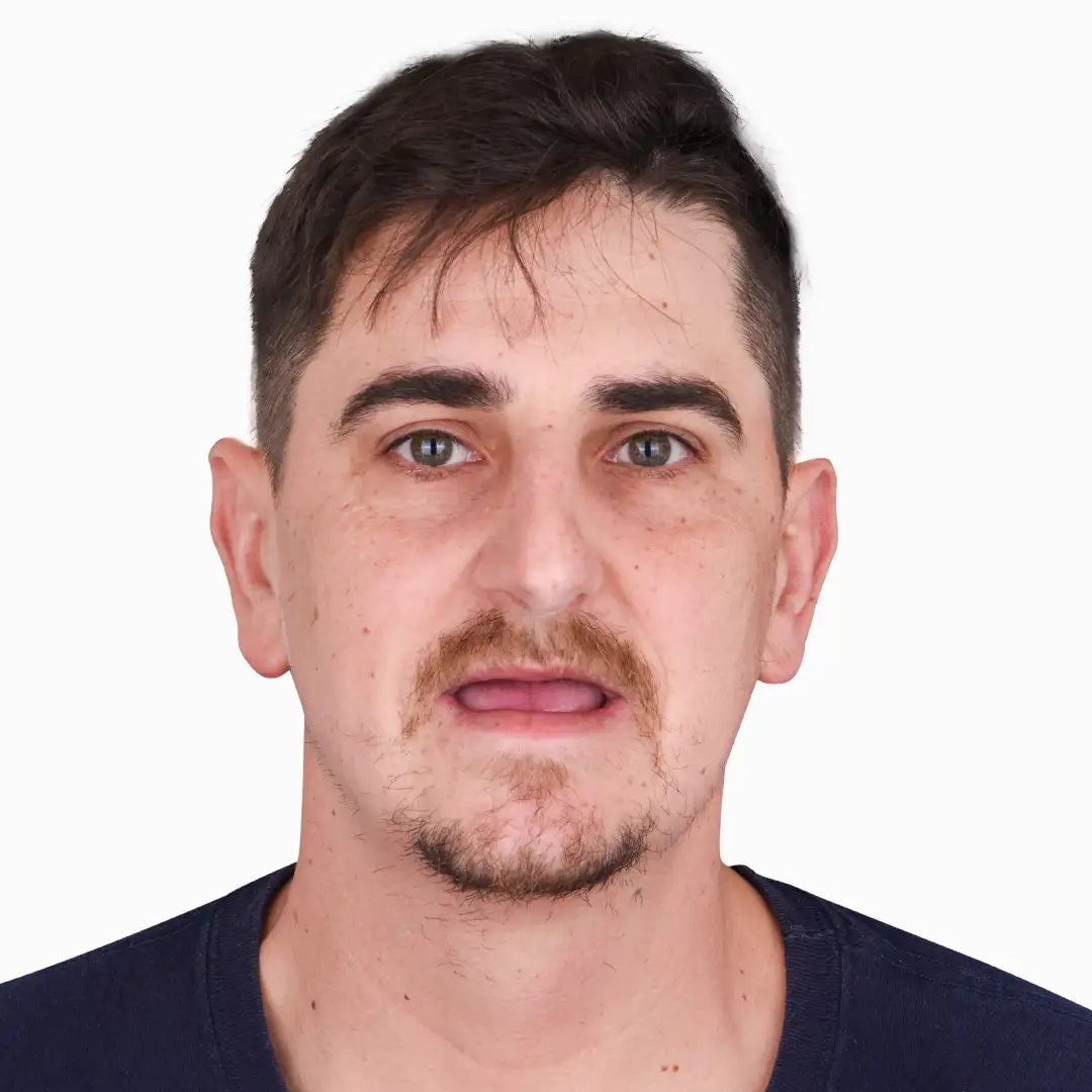 Transformation of a patient's smile before and after dental implants in Puerto Vallarta, showcasing successful restoration.