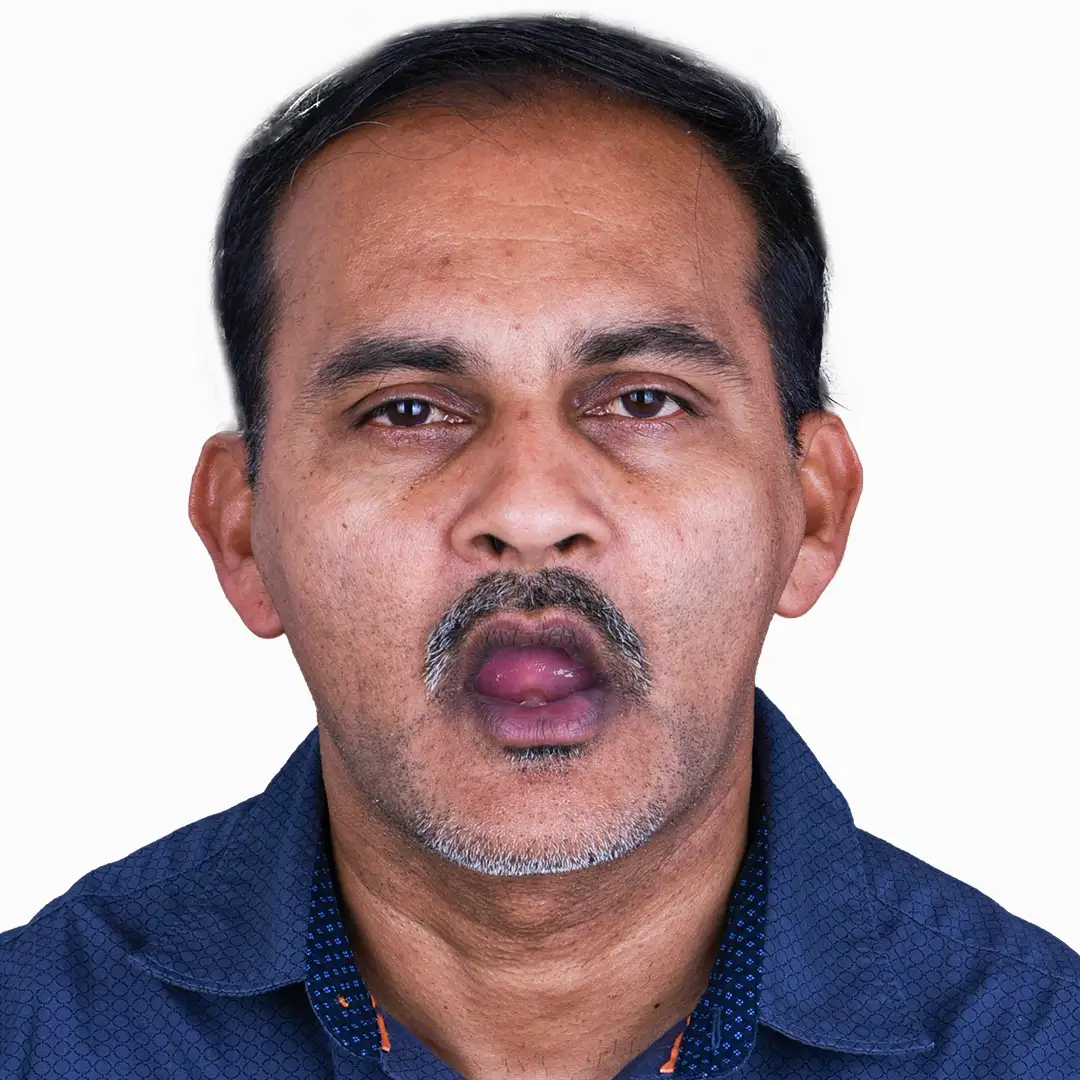 Detailed before and after images of dental implants in Puerto Vallarta, highlighting the improvement in smile confidence.