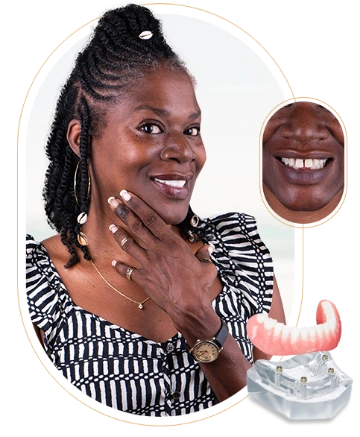 Snap-on dentures in Mexico, offering a removable yet secure solution for patients seeking affordable tooth replacement options