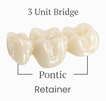 Three-unit dental bridge, showing the cost breakdown.