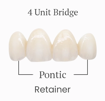 Four-unit dental bridge, showing the cost breakdown.