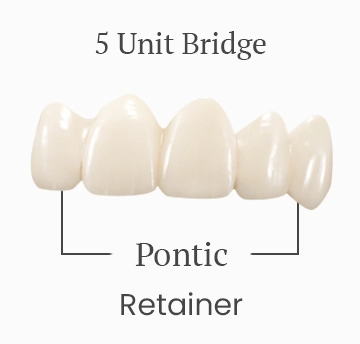 Five-unit dental bridge, showing the cost breakdown.