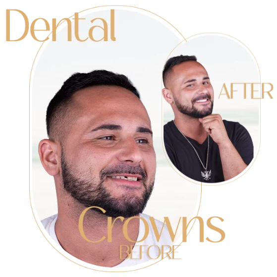 highlighting the benefits of dental crowns in Puerto Vallarta