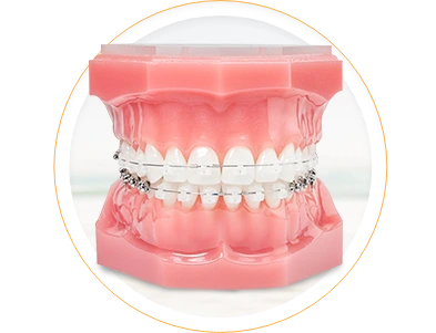Image of ceramic braces in Mexico, showing their subtle, tooth-colored appearance for discreet orthodontic treatment