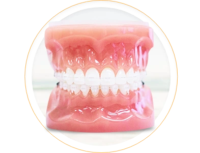 Damon braces system used in Mexico; featuring self-ligating brackets for faster, more comfortable treatment