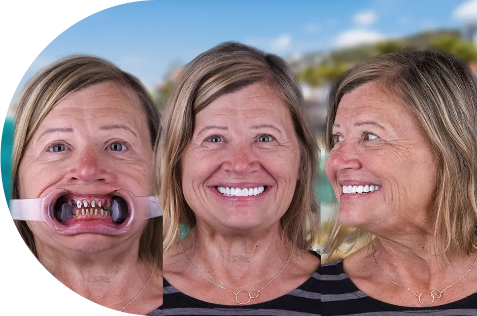 Dental bridges being placed on a patient in Puerto Vallarta, Mexico