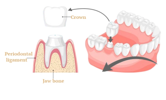 A diagram of a dental crown with labels explaining its parts