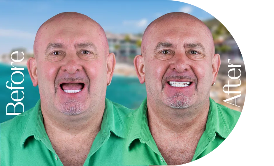 Teeth whitening treatment in Puerto Vallarta, offering brighter, whiter smiles