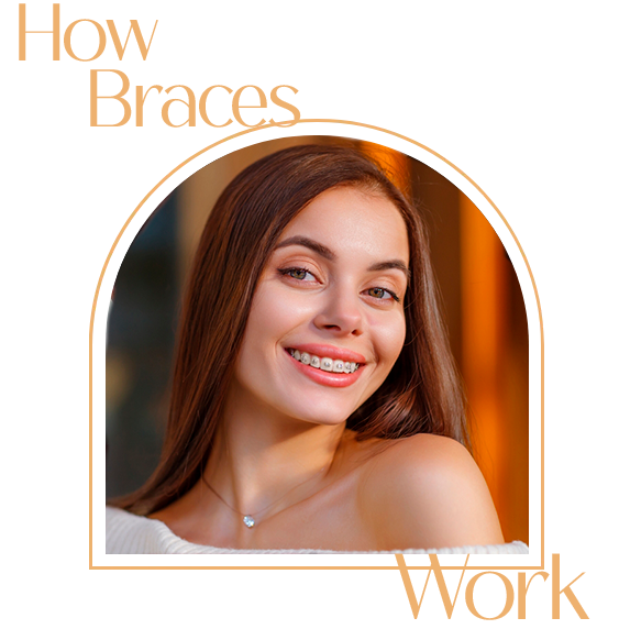 Explanation of how braces work at Puerto Vallarta Dentistry, from consultation to beautiful results