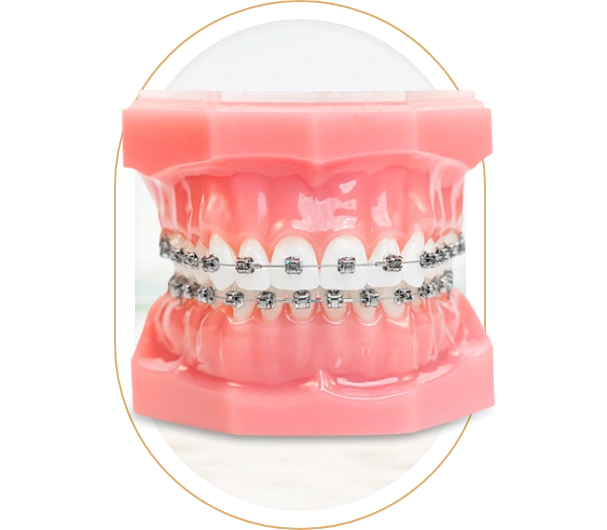 Traditional metal braces in Mexico; showing their durable design and effectiveness in teeth straightening