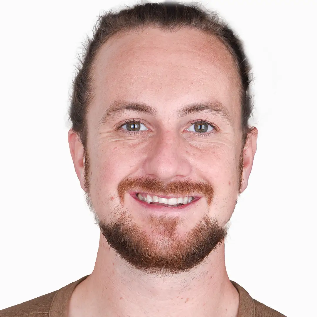 A before-and-after image of a patient with dental crowns in Mexico.