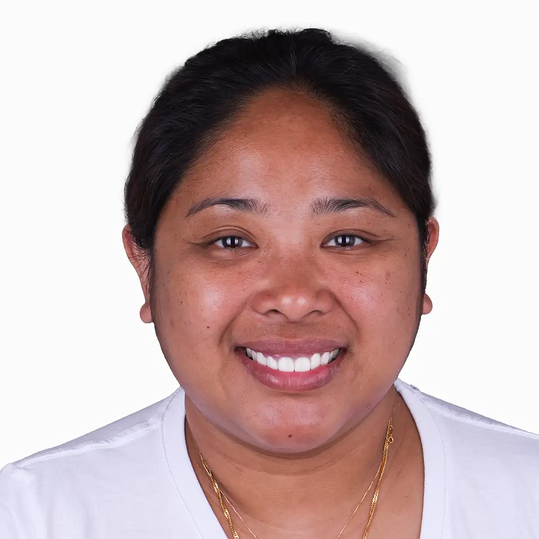 A before-and-after image of a patient with dental crowns in Mexico.