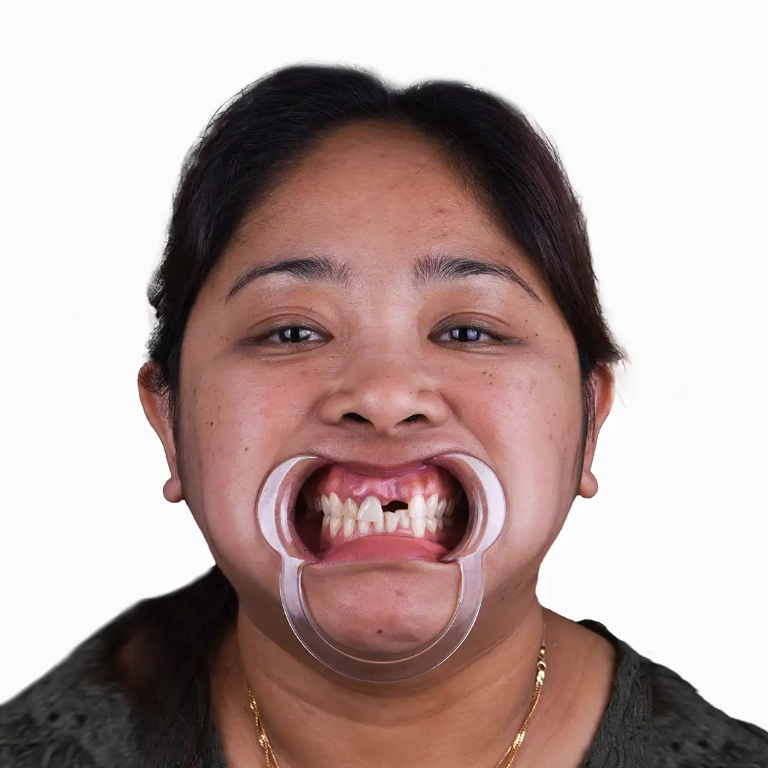 A before-and-after image of a patient with dental crowns in Mexico.