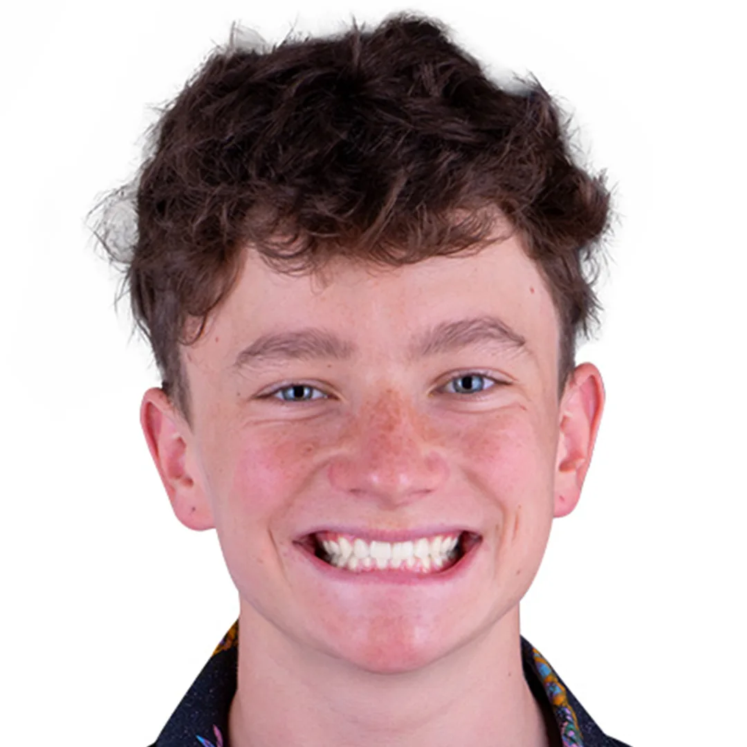 Before and after comparison of dental implants in Puerto Vallarta, showing dramatic improvement in smile aesthetics