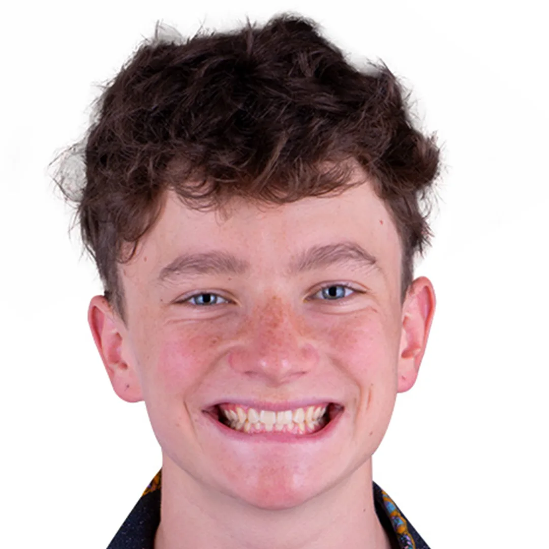 Transformation of a patient's smile before and after dental implants in Puerto Vallarta, showcasing successful restoration.