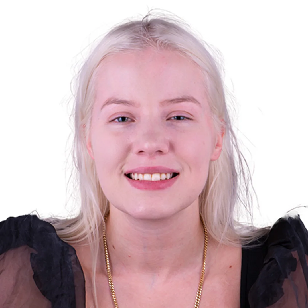 Before and after photos of dental implants in Puerto Vallarta, illustrating the enhancement of dental function and appearance.