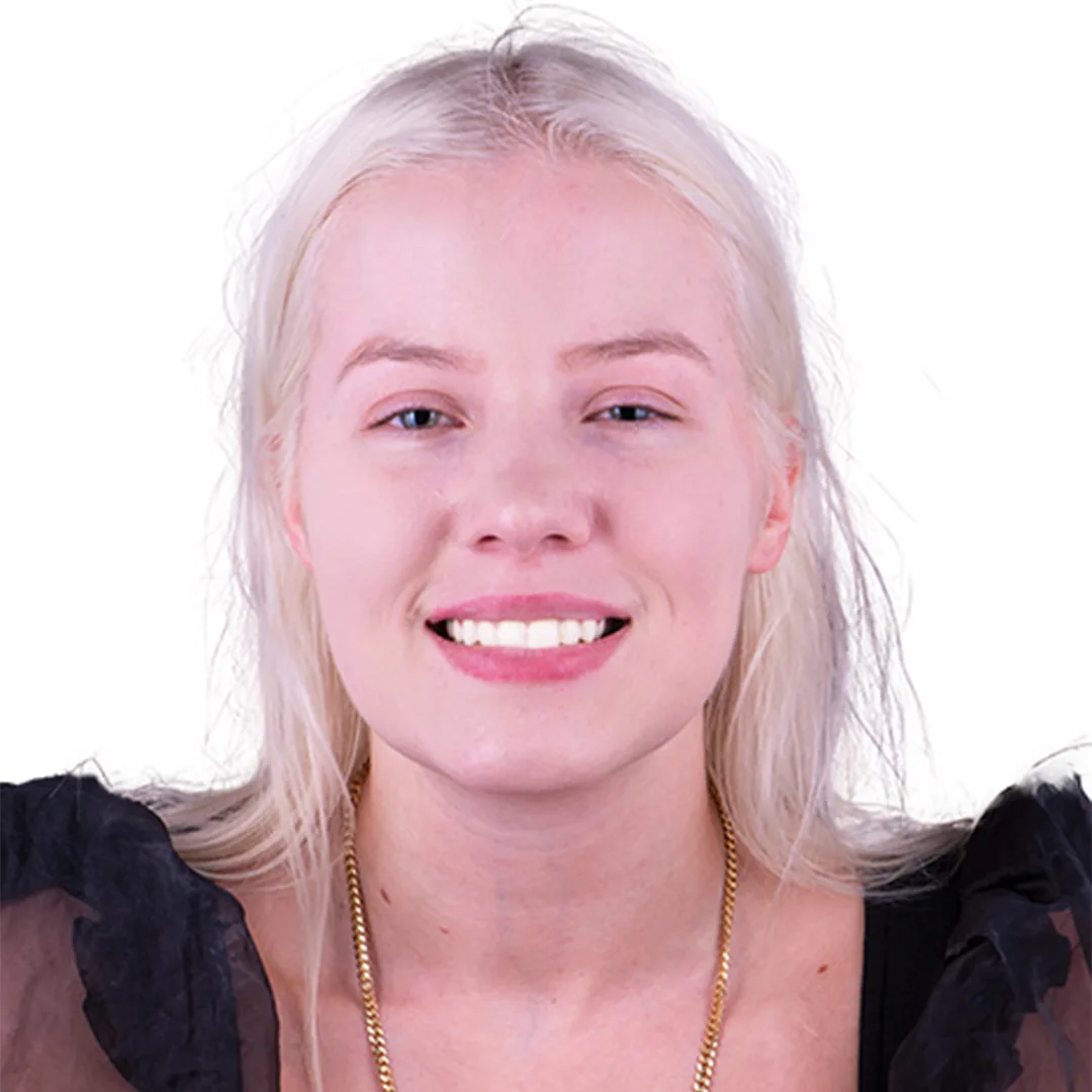 Close-up of before and after images of a dental implant procedure in Puerto Vallarta, highlighting restored teeth.