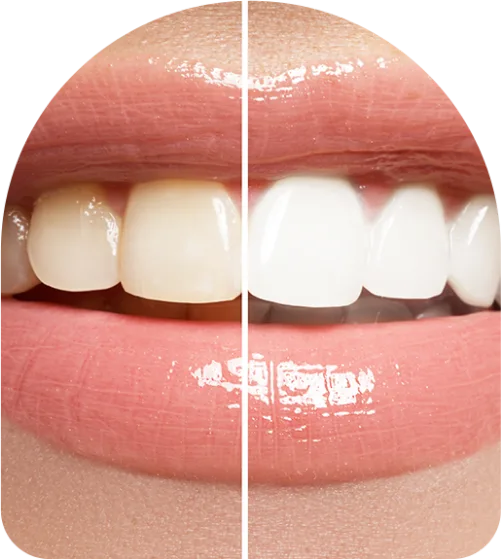 Professional teeth whitening services available in Puerto Vallarta, Mexico