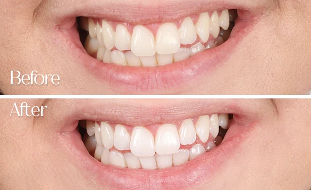 A teeth whitening tray designed for at-home whitening treatment.